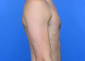 Gynecomastia Surgery Before & After Image