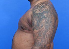 Gynecomastia Surgery Before & After Image