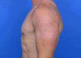 Gynecomastia Surgery Before & After Image