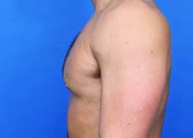 Gynecomastia Surgery Before & After Image