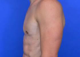 Gynecomastia Surgery Before & After Image