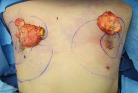 Gynecomastia Surgery Before & After Image