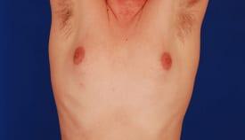 Gynecomastia Surgery Before & After Image