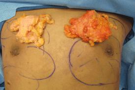 Gynecomastia Surgery Before & After Image