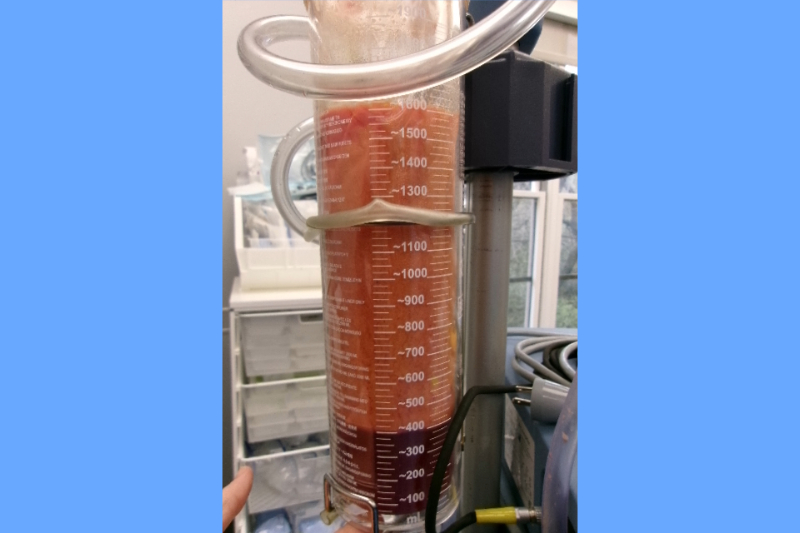 Gynecomastia Surgery Before & After Image