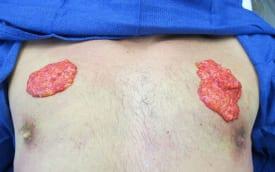 Gynecomastia Surgery Before & After Image