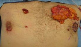 Gynecomastia Surgery Before & After Image