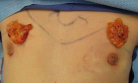 Gynecomastia Surgery Before & After Image