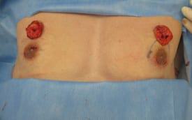 Gynecomastia Surgery Before & After Image