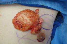 Gynecomastia Surgery Before & After Image