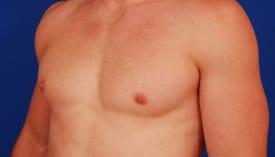 Gynecomastia Surgery Before & After Image