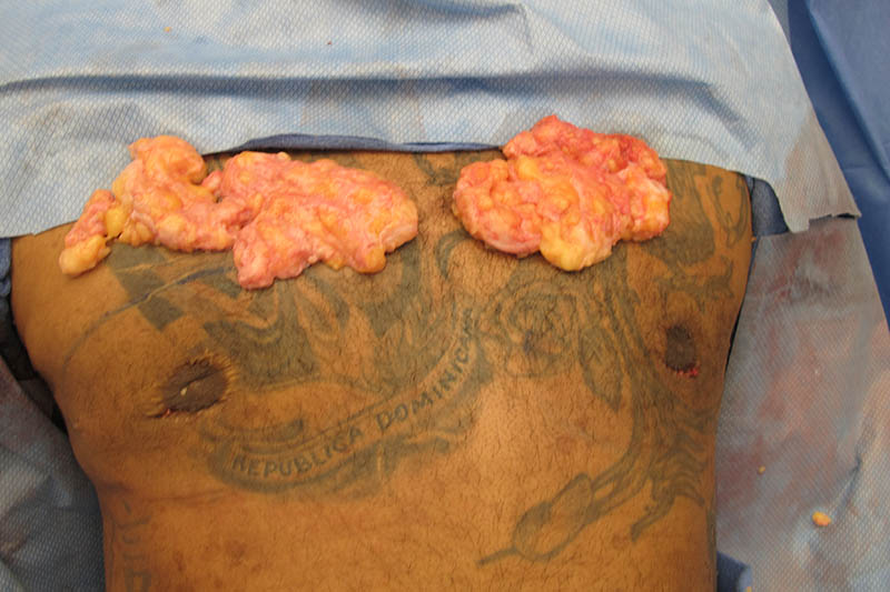 Revision Gynecomastia Surgery Before & After Image