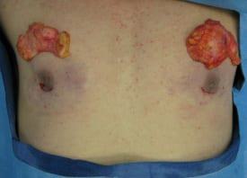 Revision Gynecomastia Surgery Before & After Image