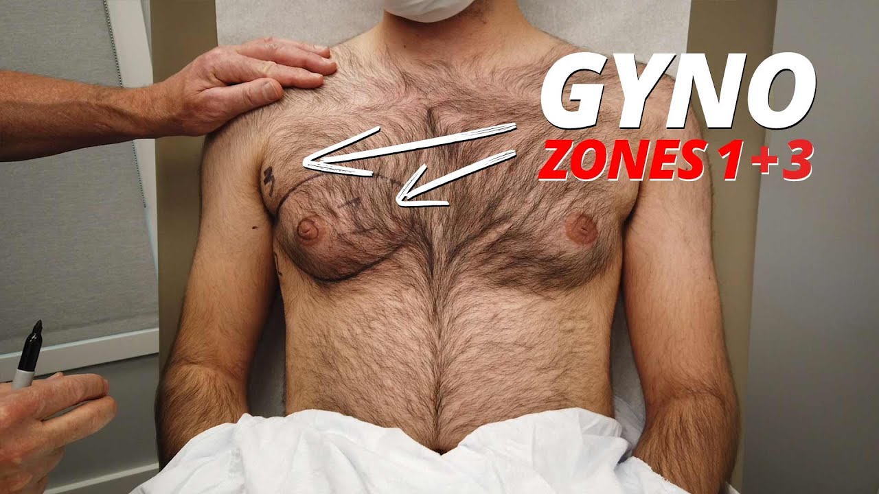 Gynecomastia zones video