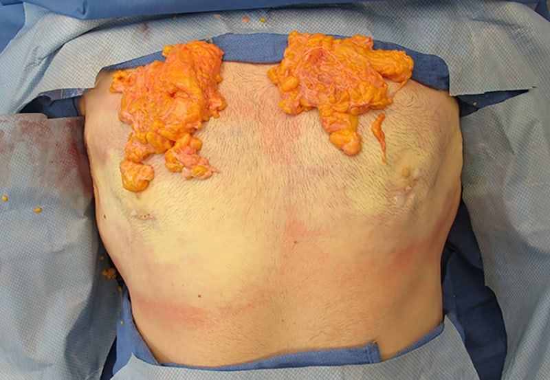 Gynecomastia Surgery Before & After Image