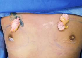 Gynecomastia Surgery Before & After Image