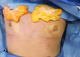 Gynecomastia Surgery Before & After Image