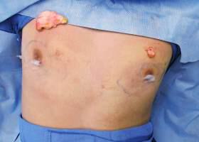 Gynecomastia Surgery Before & After Image