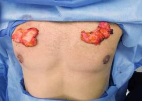 Gynecomastia Surgery Before & After Image