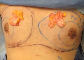 Gynecomastia Surgery Before & After Image