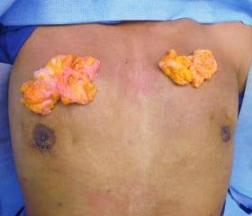 Gynecomastia Surgery Before & After Image