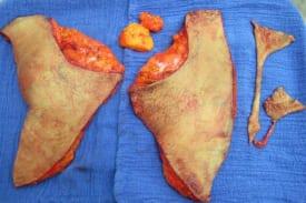 Gynecomastia Surgery Before & After Image