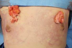 Gynecomastia Surgery Before & After Image