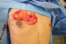 Gynecomastia Surgery Before & After Image