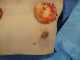 Gynecomastia Surgery Before & After Image