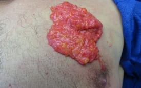 Gynecomastia Surgery Before & After Image