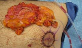 Gynecomastia Surgery Before & After Image