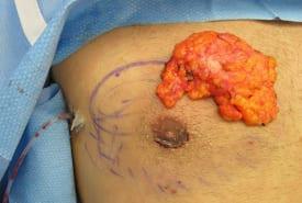 Gynecomastia Surgery Before & After Image