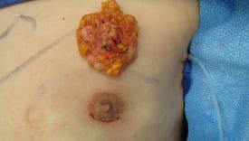 Gynecomastia Surgery Before & After Image