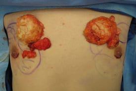 Gynecomastia Surgery Before & After Image