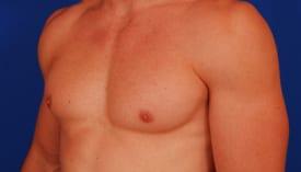 Gynecomastia Surgery Before & After Image