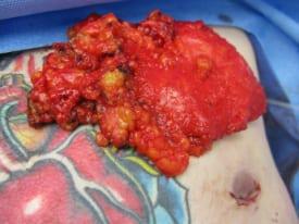 Gynecomastia Surgery Before & After Image