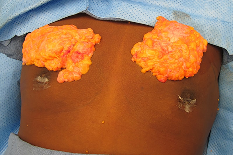 Gynecomastia Surgery Before & After Image