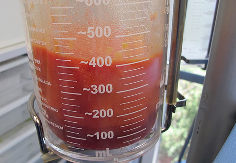 Gynecomastia Surgery Before & After Image