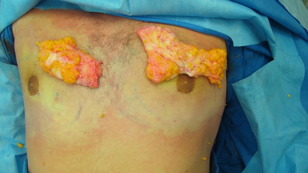 Gynecomastia Surgery Before & After Image