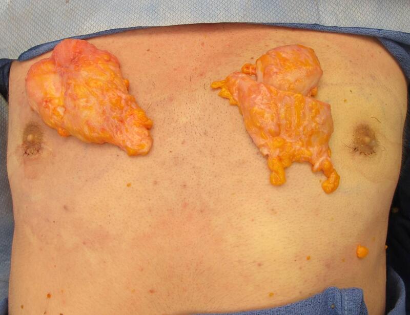 Gynecomastia Surgery Before & After Image