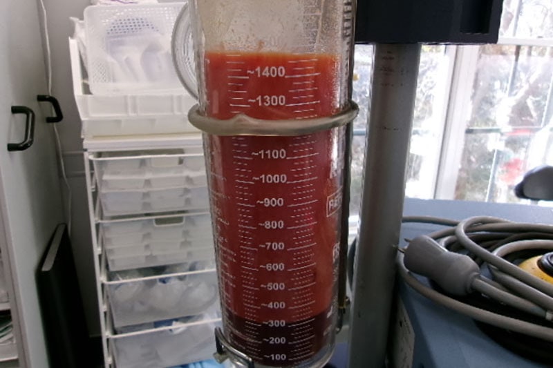 Gynecomastia Surgery Before & After Image