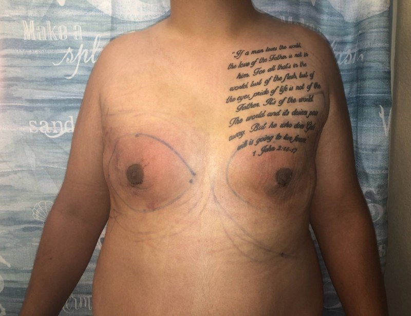 Gynecomastia Surgery Before & After Image