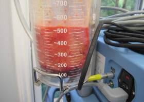 Gynecomastia Surgery Before & After Image