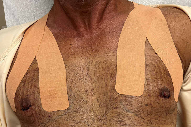 Gynecomastia Surgery Before & After Image