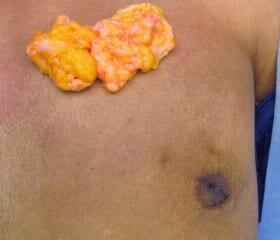 Gynecomastia Surgery Before & After Image