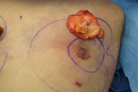 Gynecomastia Surgery Before & After Image