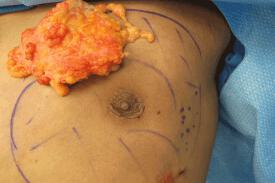 Gynecomastia Surgery Before & After Image