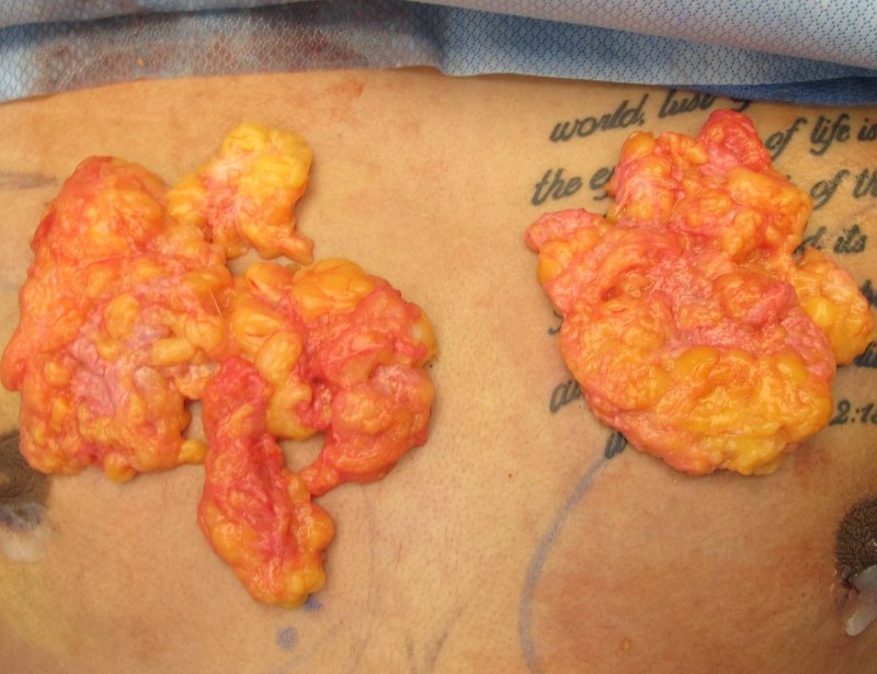 Gynecomastia Surgery Before & After Image