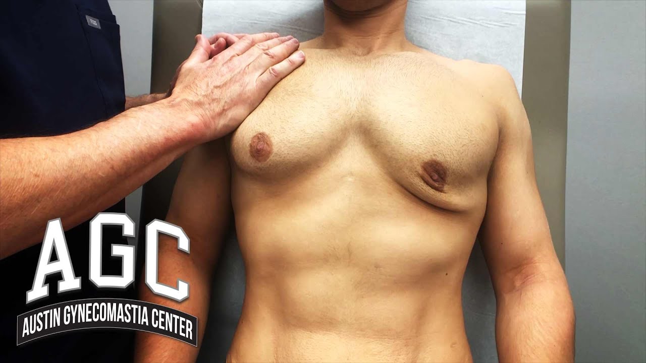 AGC Gynecomastia patient video