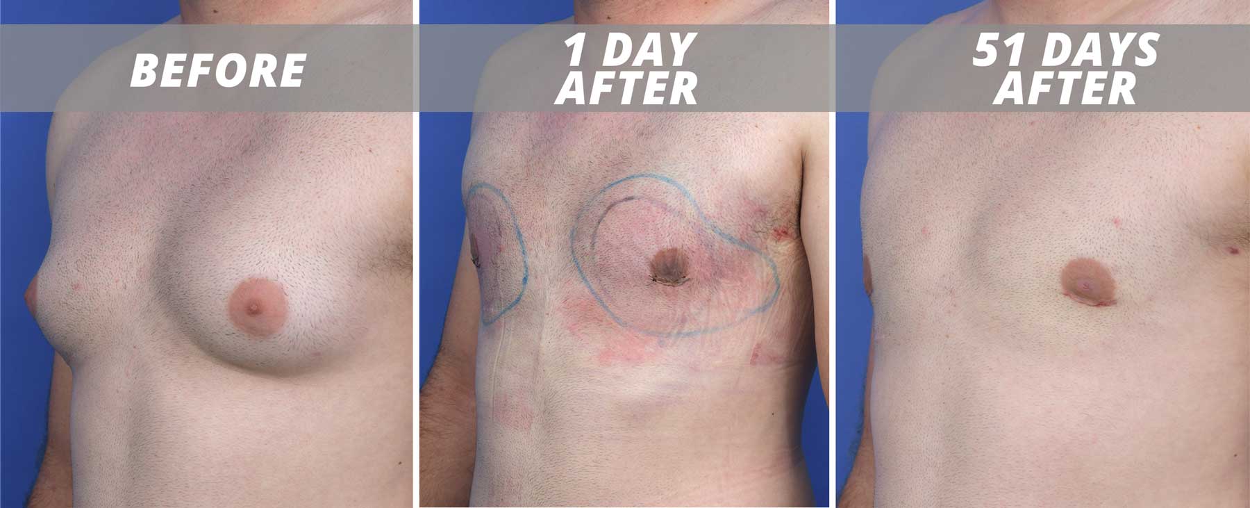 Man after gynecomastia surgery